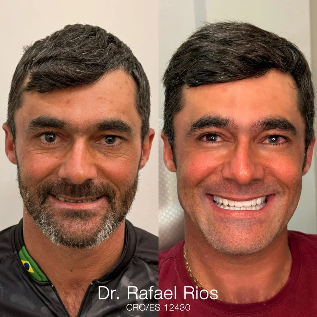 Comparativo de sorriso de antes e depois