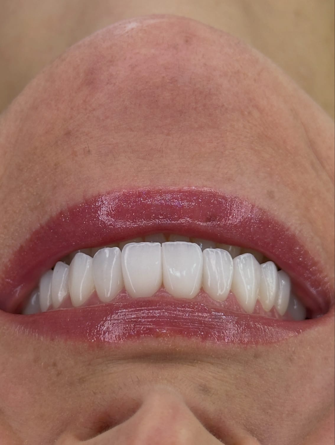 Resultado odontológico de sorriso